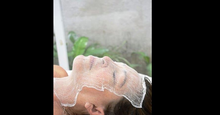 Tratamiento facial con Microdermoabrasión y Radiofrecuencia