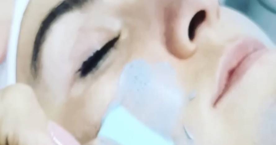 Limpieza facial con Derma Pen, borra las pequeñas imperfecciones