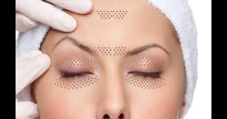 Plasma Pen bleferoplastia sin cirugia en párpados, ojera, surco...