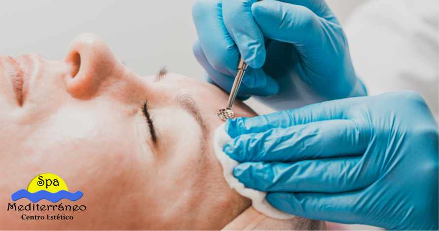 Limpieza profunda anti acné en rostro o espalda