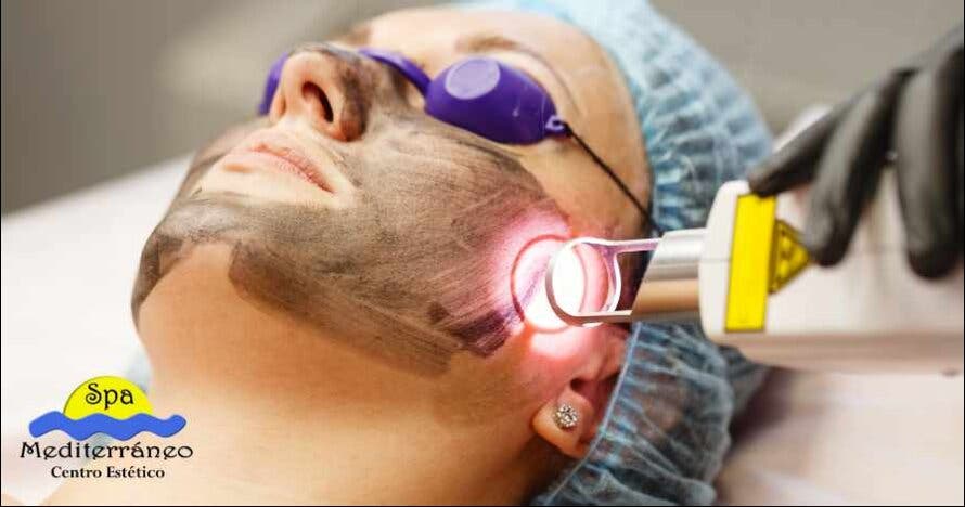 Hollywood peel