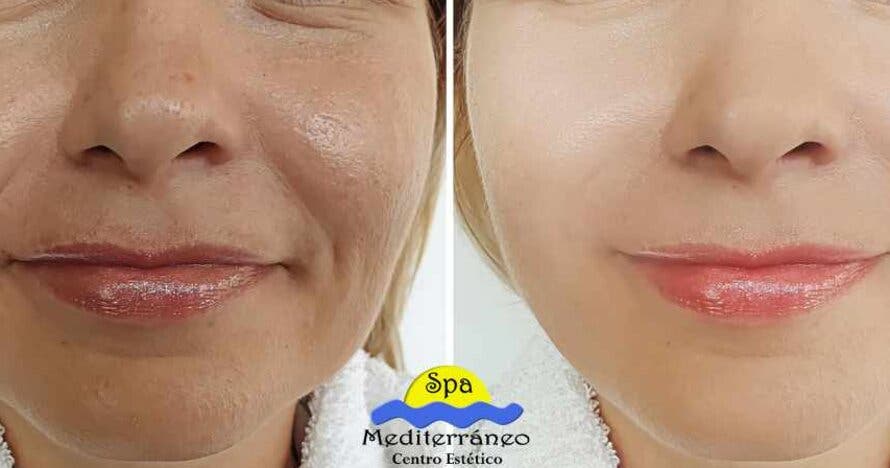 Rejuvenecimiento facial avanzado