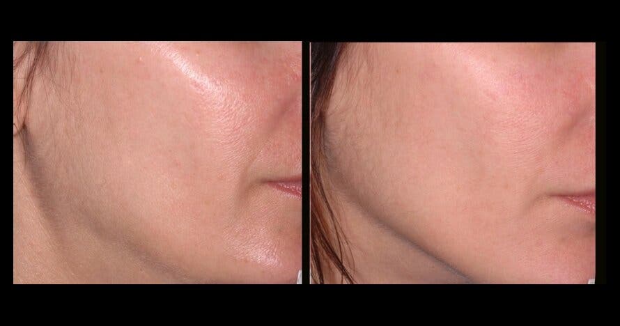Ultralifting facial: rejuvenece tu rostro sin cirugía