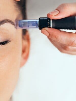 Tratamiento facial y ojeras, Dermapen médico y Eyes Peptides