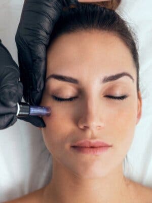 Tratamiento facial-manchas, dermapen médico y Melanyc Peptide