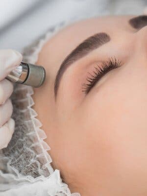 Tratamiento facial con Microdermoabrasión con punta de diamante