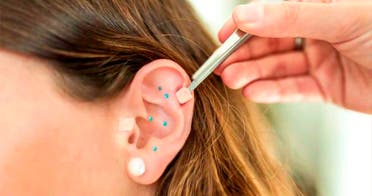  Auriculoterapia 4 Sesiones 